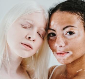 Ženy s albinismema a vitiligem na pokožce. 