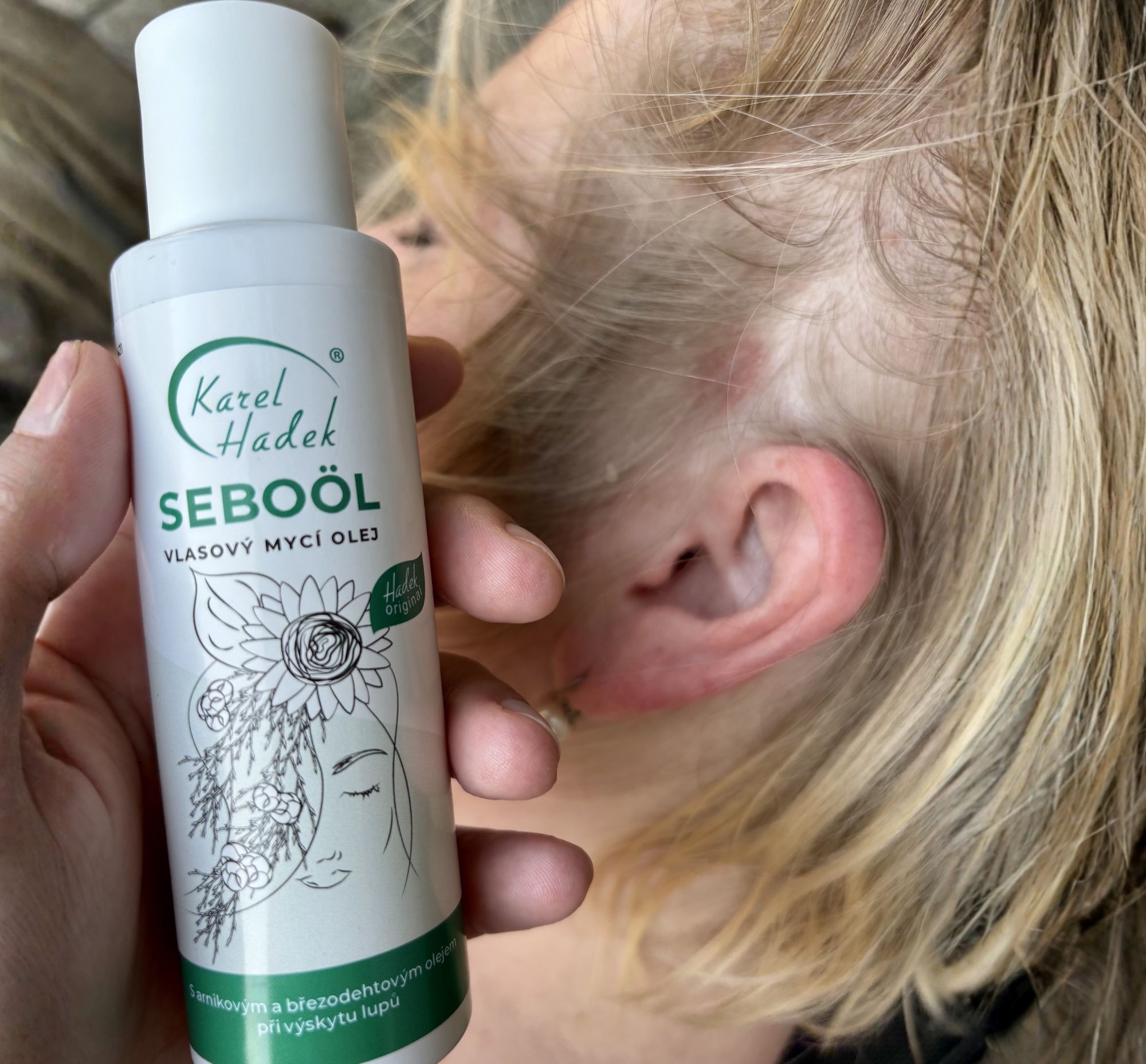 Lupénka ve vlasech a přípravek Seboöl od AKH cosmetics