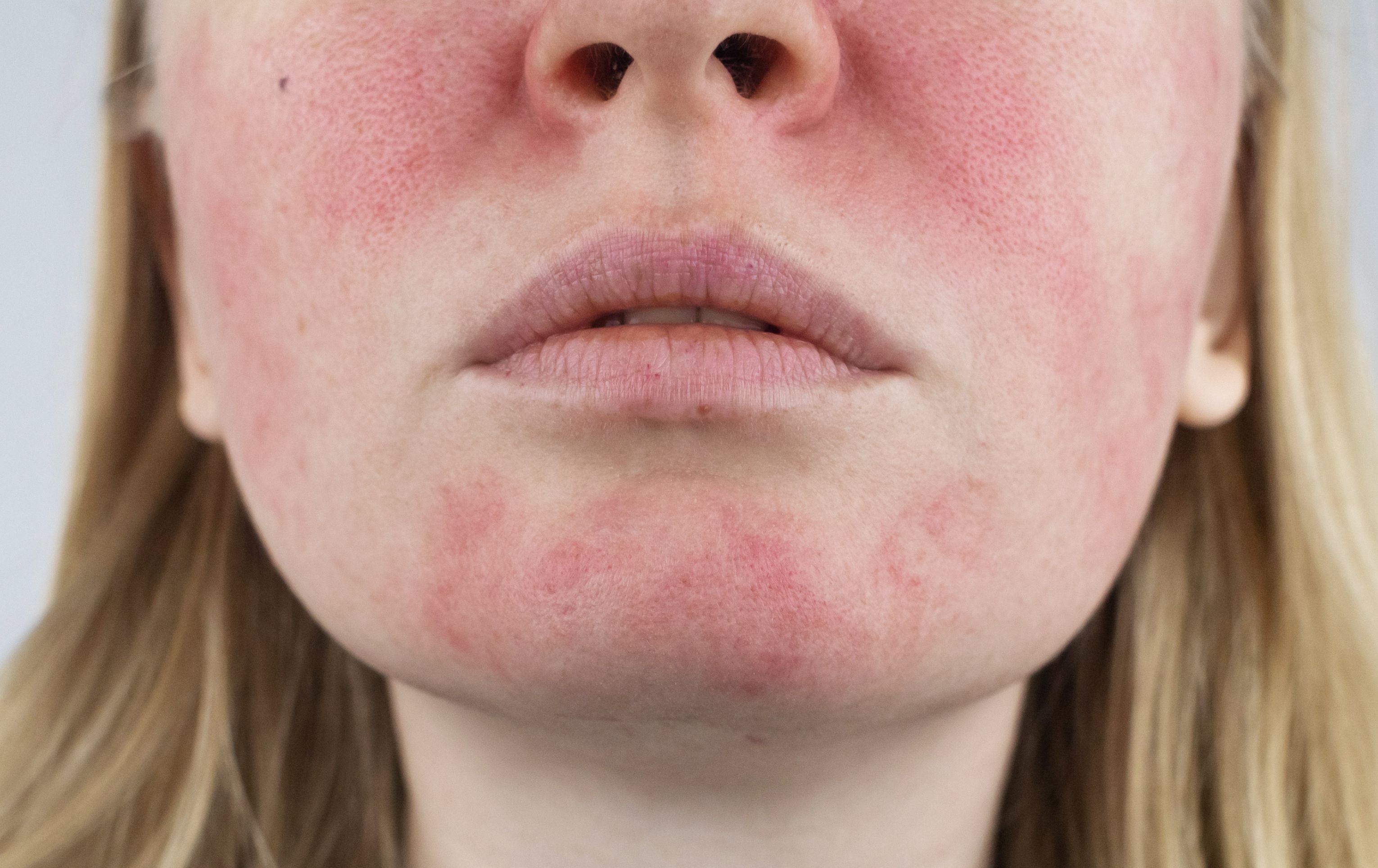 Trápí vás kuperóza nebo rosacea?