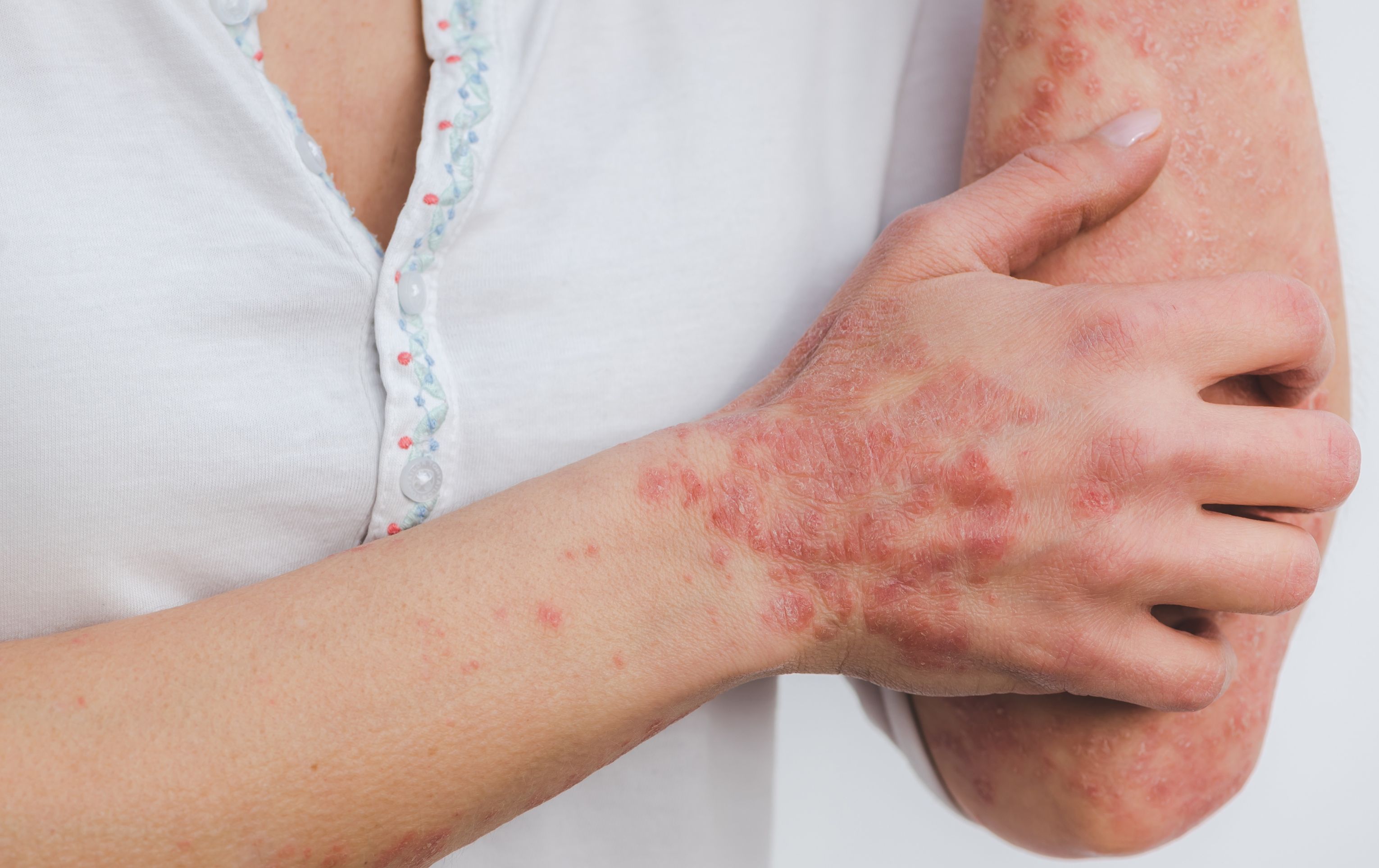 Lupénka: Jak na ni vyzrát s pomocí aromaterapie?